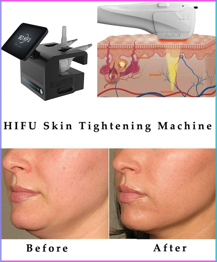 Máy nâng cơ HIFU 8D