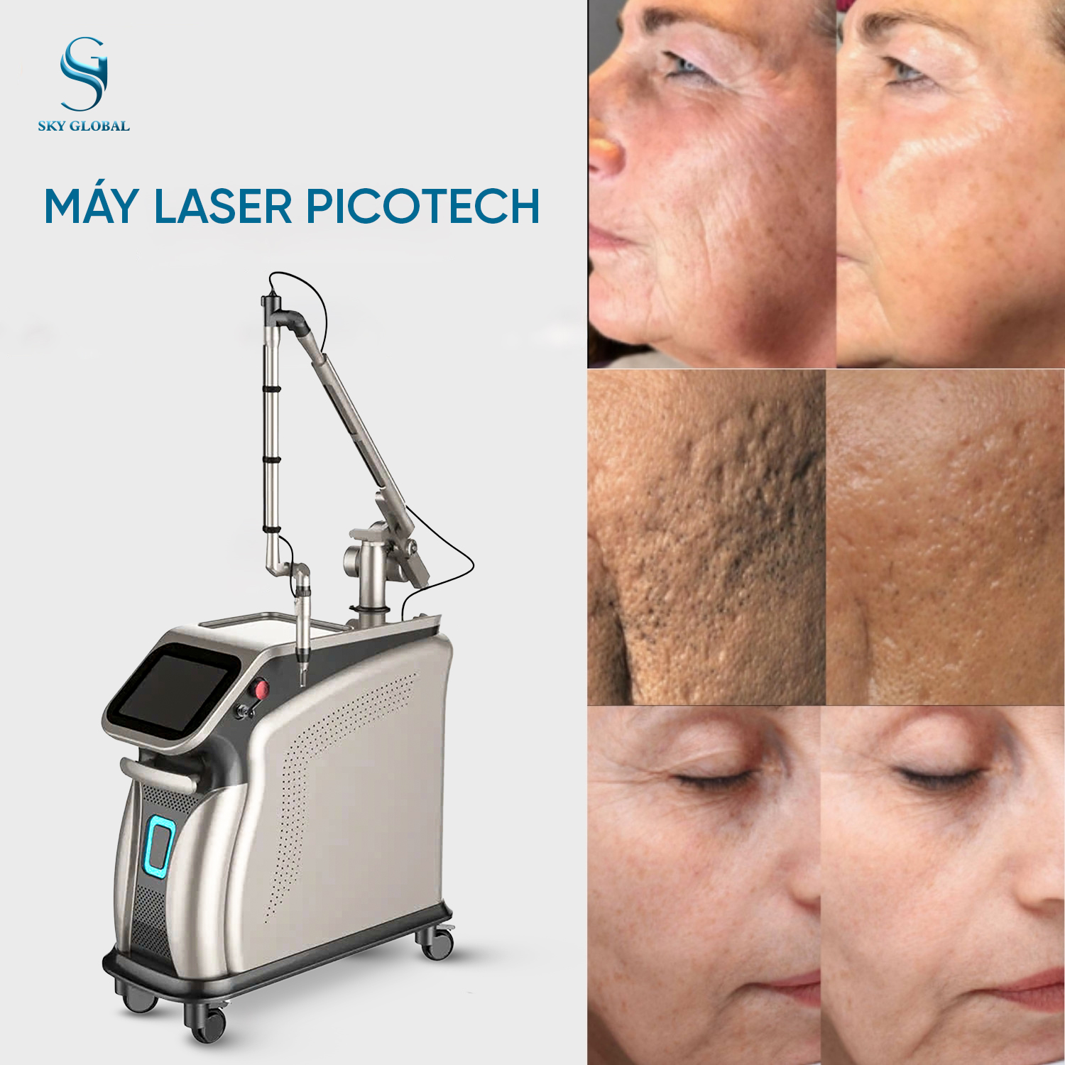 Laser Picotech trẻ hóa da bằng công nghệ Pico