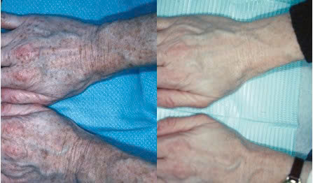 Máy laser Picotech cho spa và phòng khám da liễu