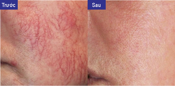 Ứng dụng laser xung dài trong điều trị da và triệt lông