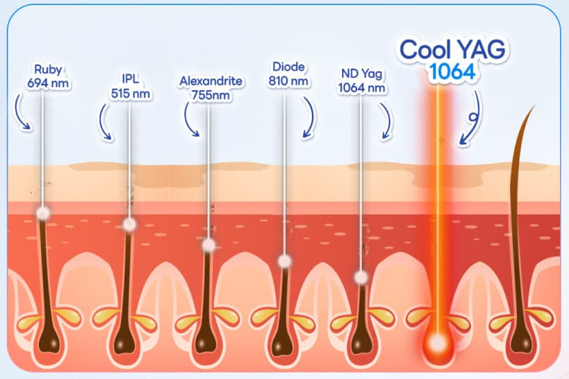 Nguyên lý hoạt động của laser xung dài trong điều trị da