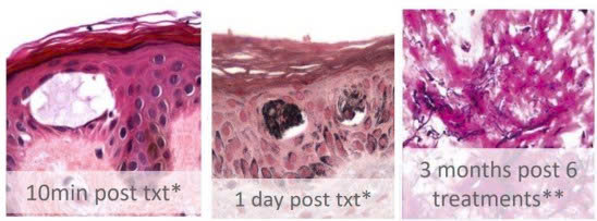 Máy laser Picotech công nghệ Pico điều trị da thẩm mỹ