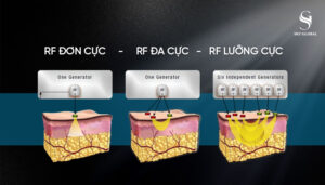 RF đơn cục, rf đa cực, rf lưỡng cực khác nhau như thế nào?