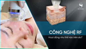 Công nghệ RF hoạt động như thế nào trên da