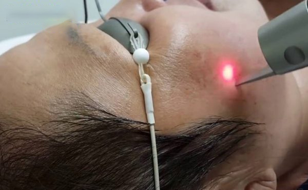 Laser Pico trị nám mảng
