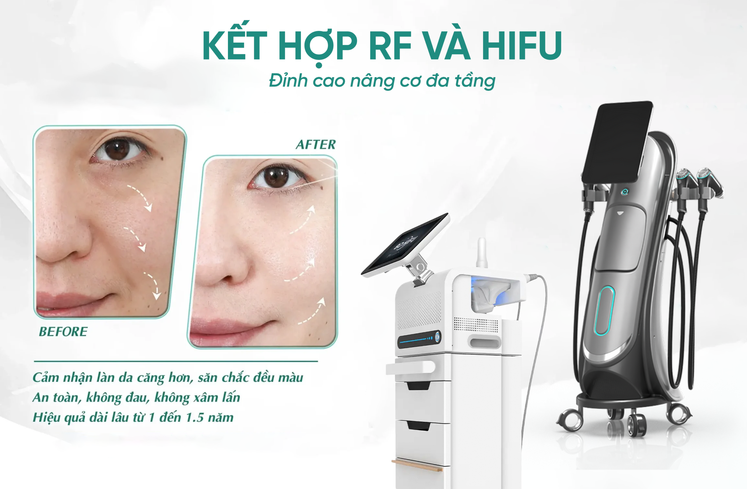 RF kết hợp với Hifu đỉnh cao nâng cơ