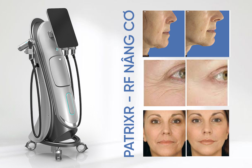 PatrixR - Sử dụng công nghệ RF nâng cơ 