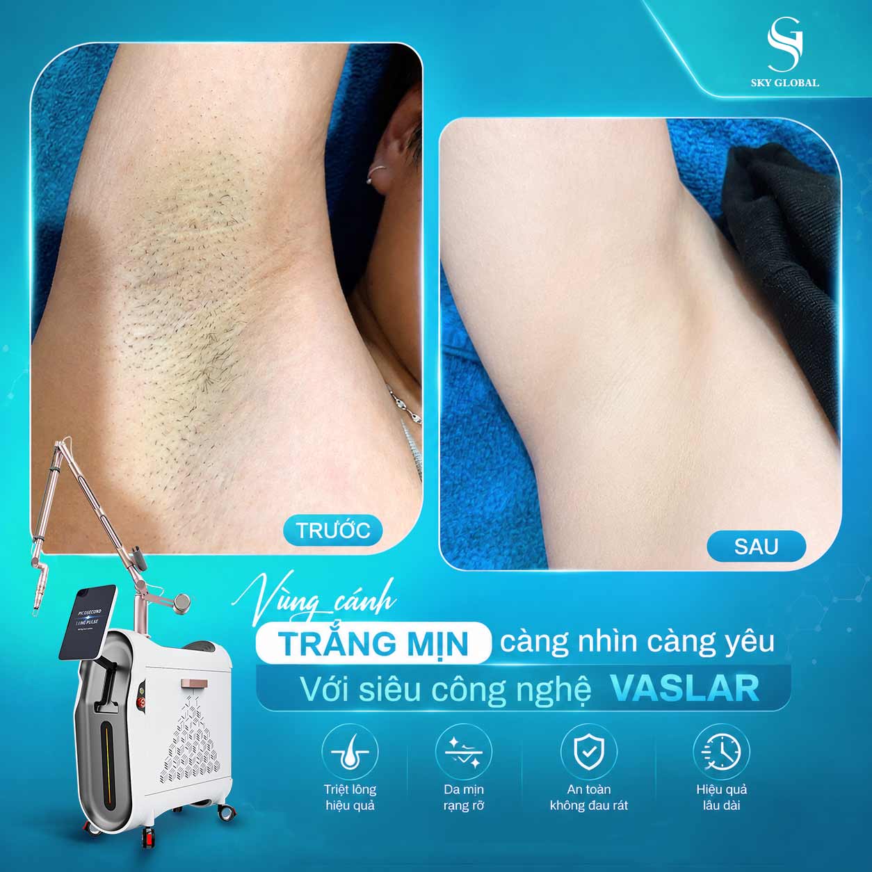 Máy laser xung dài Vaslar ứng dụng triệt lông hiệu quả